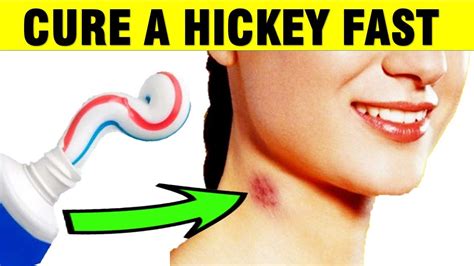 love bite on breast|How to Get Rid of Hickeys: Stages, Love Bite。